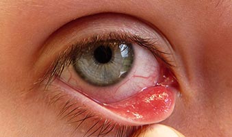 Blepharitis Treatment in mumbai Blepharitis Treatment in mumbai