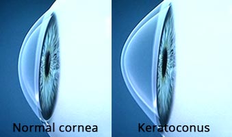 Symptoms and Signs Of Keratoconus