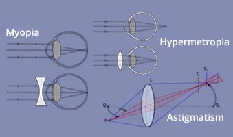 astigmatism hypermetropic