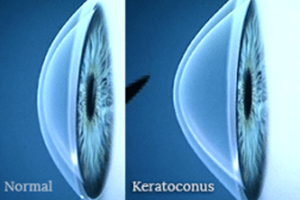 Is Lasik the right treatment for Keratoconus?