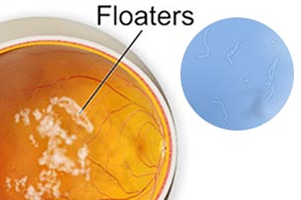A doctor’s guide to Flashes & Floaters