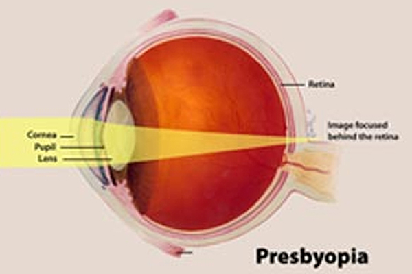 The what, how and when of Presbyopia: the inability to focus
