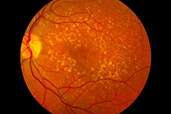 The most common cause of irreversible vision loss among the aged