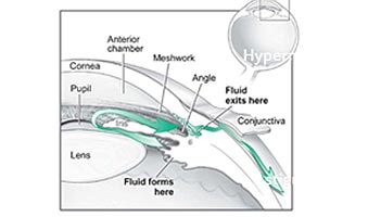 Glaucoma Treatment In Mumbai Glaucoma Treatment In Mumbai