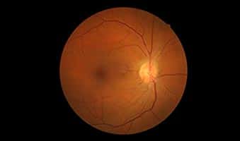 Diabetic retinopathy treatment in mumbai